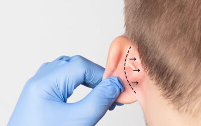 Otoplastia: Cirugía de corrección de orejas