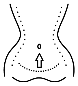 abdominoplastia ideal