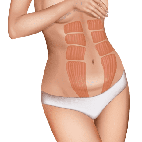 diastasis abdominal asociada