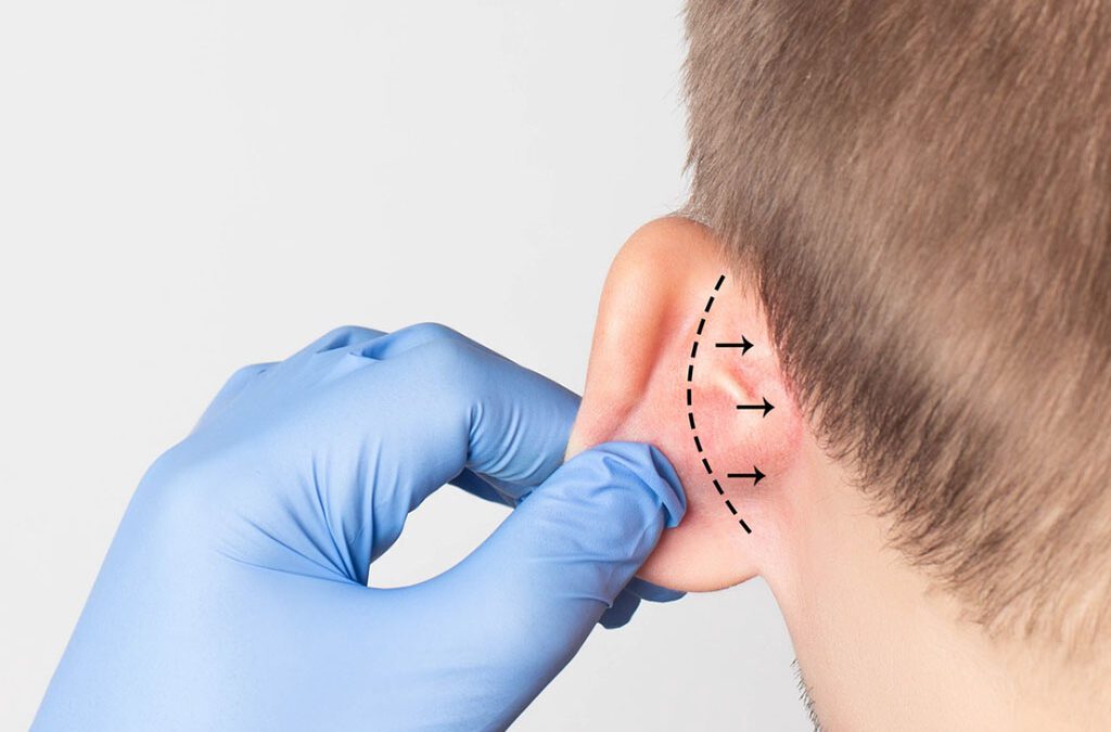 Otoplastia: Cirugía de corrección de orejas