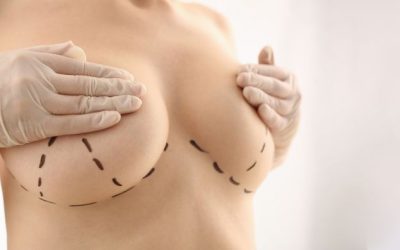 5 preguntas y respuestas comunes sobre las mamas tuberosas