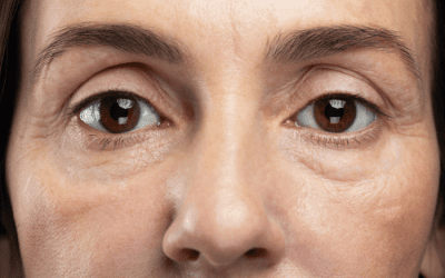 ¿Cómo podemos eliminar las bolsas de los ojos? Una mirada a la blefaroplastia